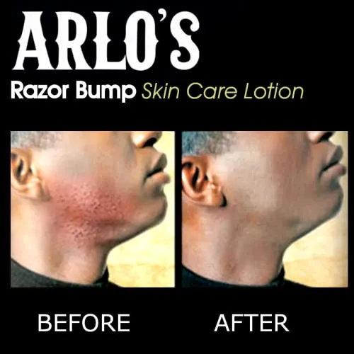 Arlos Razor Bump Skin Care Lotion 177ml